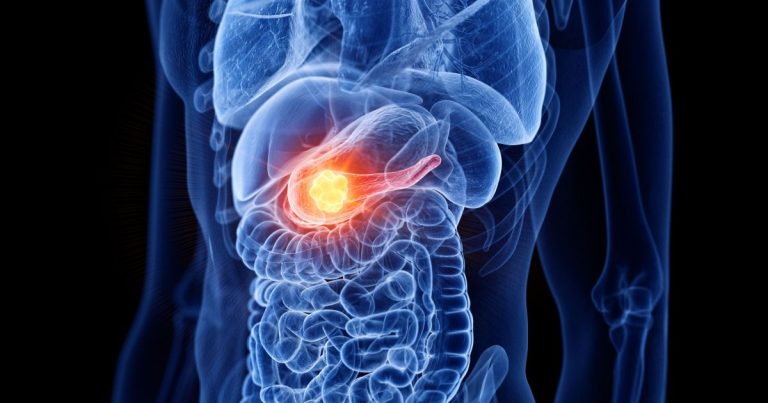 CÂNCER DE PÂNCREAS: NOVO ESTUDO REVELA PROTEÍNA CRUCIAL