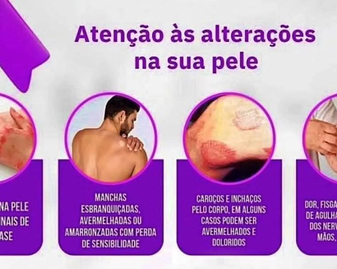 HANSENÍASE: SECRETARIA DE SAÚDE DE CASTILHO PROMOVE CAMPANHA