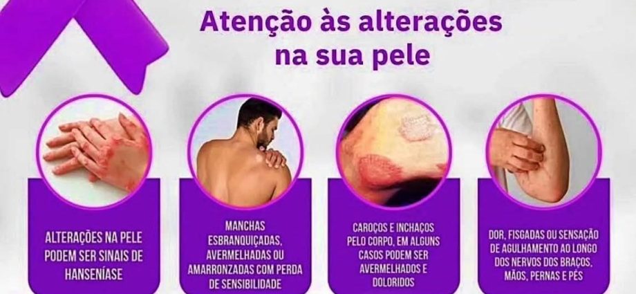 HANSENÍASE: SECRETARIA DE SAÚDE DE CASTILHO PROMOVE CAMPANHA