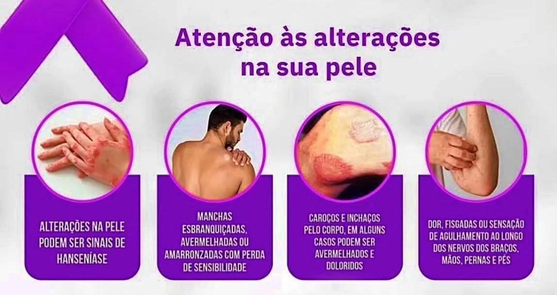 HANSENÍASE: SECRETARIA DE SAÚDE DE CASTILHO PROMOVE CAMPANHA