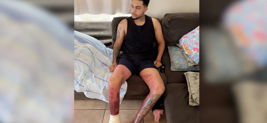 Jovem de Votuporanga recebe alta após queimaduras em explosão com etanol